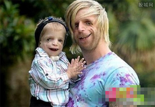 英国现真人版“卡西莫多” 男子患怪病脸部严重变形超惊悚 | 北晚新视觉