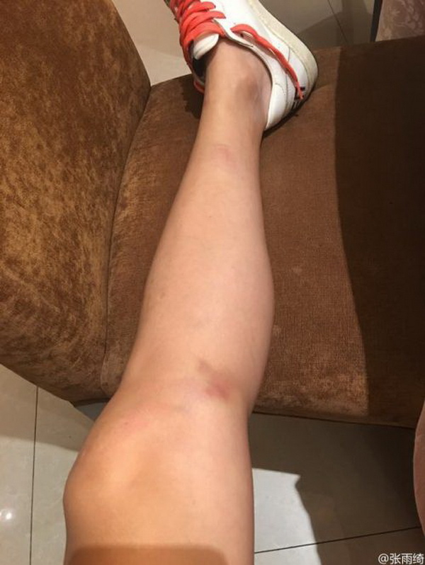 9月26日上午,张雨绮在微博晒出自己腿部受伤的照片,还配文:"强度不够