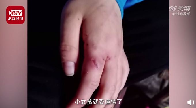 []12岁女孩遭继母家暴多处受伤，妇联：继母生了孩子，就开始虐待小女孩