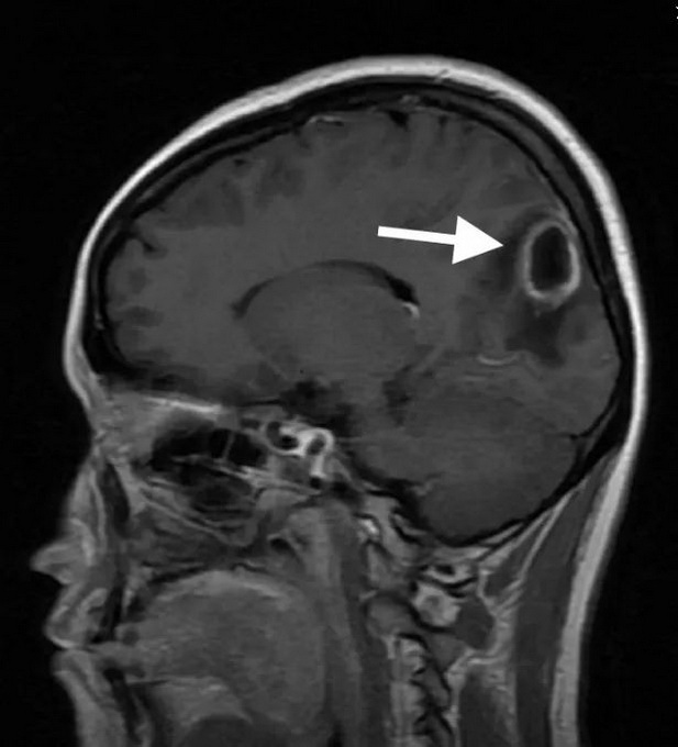 90后年轻妈妈抠了一颗青春痘，结果要进行开颅手术！