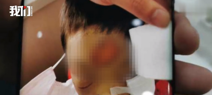 推荐黑龙江遭虐打女童已出院，昏迷近一个月才苏醒，其父已被刑拘