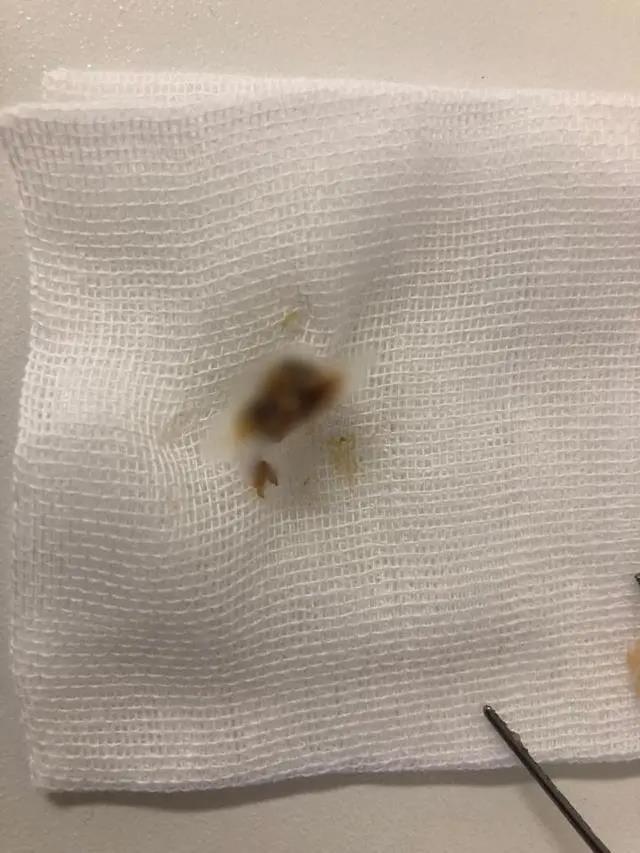 耳屎杭州姑娘一觉醒来听不见了！医生从她耳朵里挖出一大坨脏东西