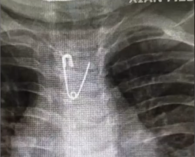 热点太危险！10个月大婴儿误食3厘米长别针，医生5分钟取出