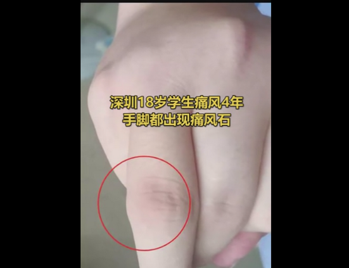 推荐“痛得我想把脚砍了！”18岁学生被痛风折磨4年！关节长出“石头”