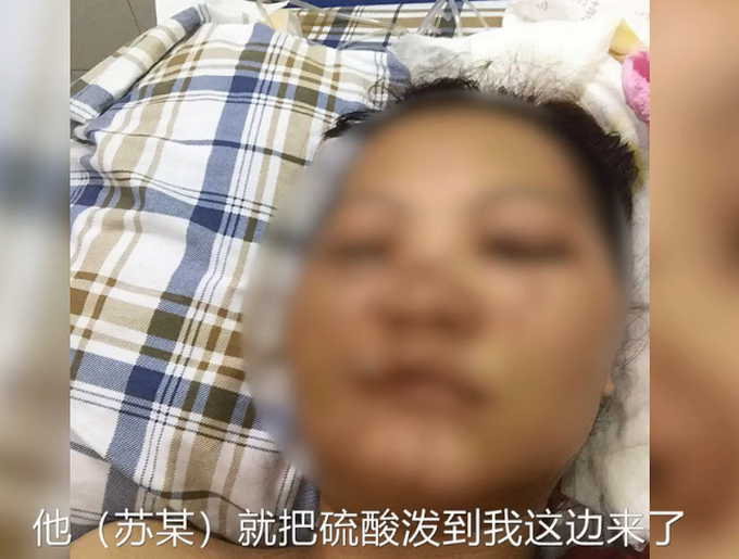 推荐女合伙人遭幼儿园长泼硫酸，警方通报：两人曾是情侣，全力追缉犯罪嫌疑人