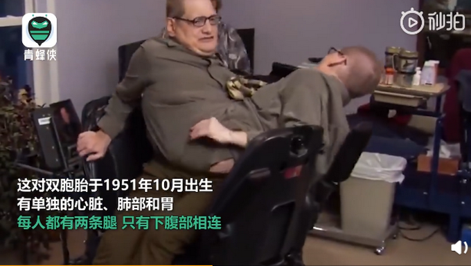 推荐一生相依！世界上最长寿连体兄弟去世，有单独心脏仅下腹相连，享年68岁