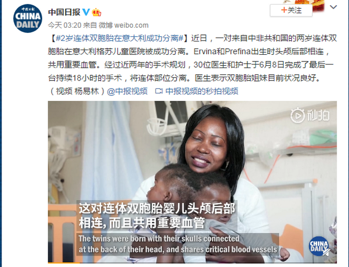 推荐|2岁连体双胞胎在意大利成功分离！此前头颅后部相连共用血管