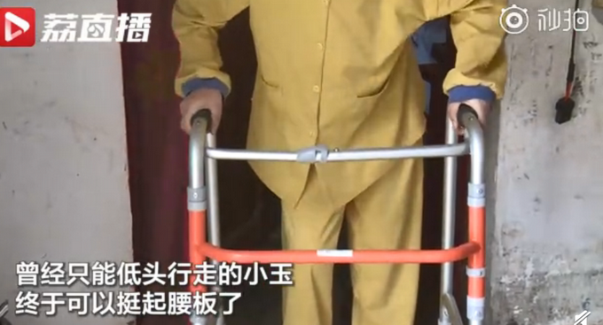 热点|4次手术，折叠女孩终能直立行走！网友：她是不幸的，也是幸运的