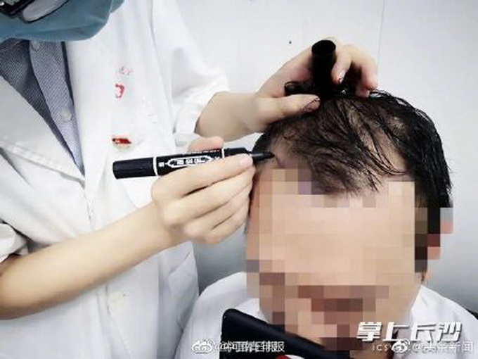 热点|20岁小伙健身半年结果秃了！医生：不恰当健身或引起脱发