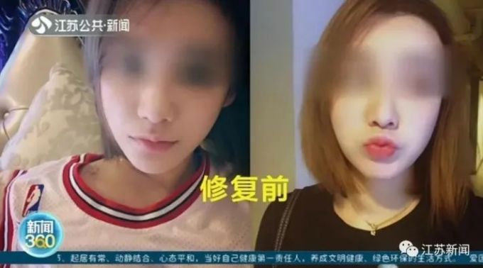 医美|女主播花2万元做“隆鼻修复术”，鼻子竟变出4个洞