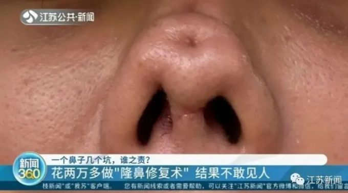 医美|女主播花2万元做“隆鼻修复术”，鼻子竟变出4个洞