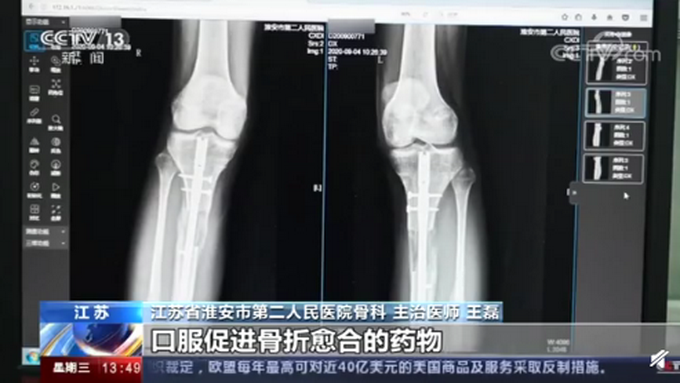 |断骨增高手术严禁用于美容项目，小伙国外手术后致双腿感染、无法行走