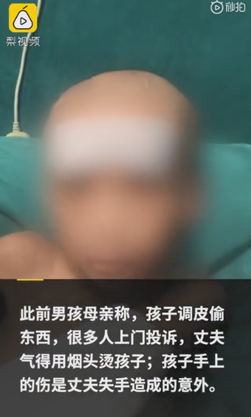 |被父亲烧伤男孩发声：爸爸妈妈一起床就打我，想与爷爷奶奶住