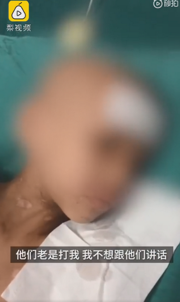 |被父亲烧伤男孩发声：爸爸妈妈一起床就打我，想与爷爷奶奶住