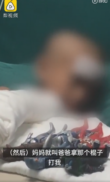 |被父亲烧伤男孩发声：爸爸妈妈一起床就打我，想与爷爷奶奶住