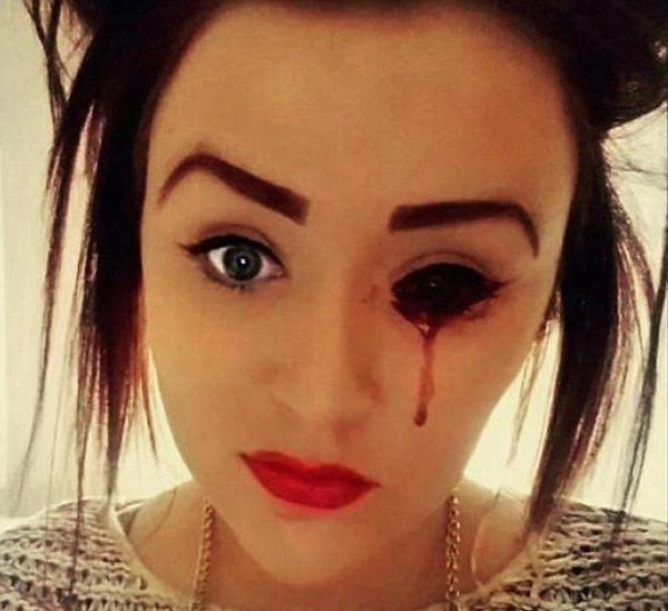 17岁英国女孩哈维眼睛每天最多出血5次,医生们无法找出病因