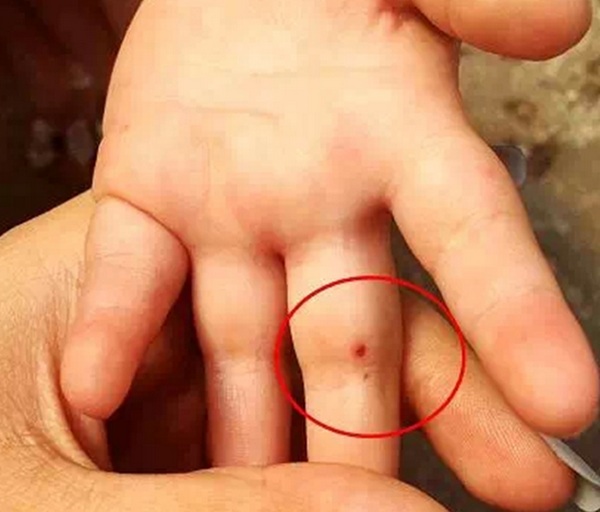 幼园儿童疑遭针扎 孩子手指被扎流血多数还被关禁闭