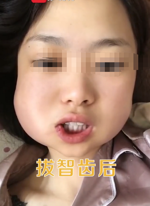 山东一女子把3颗智齿一次性拔完:手术中途吓哭,脸肿得像土拨鼠